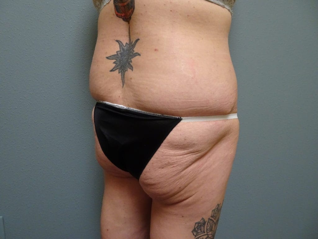 patient-25-bbl-right-oblique-before