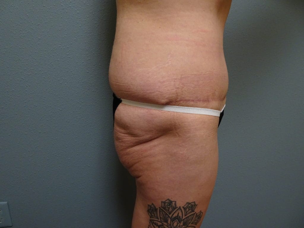 patient-25-bbl-right-side-before