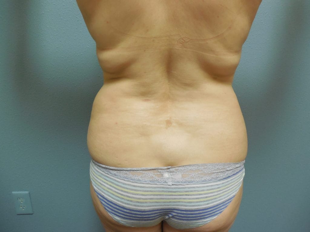 patient-59-lipo-before