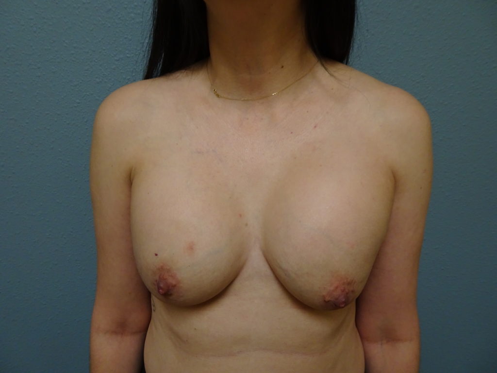 patient-8-breast-exchange-before