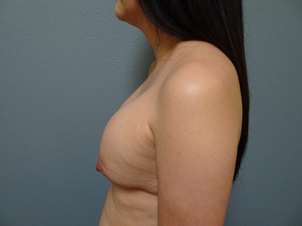 patient-8-breast-exchange-left-before