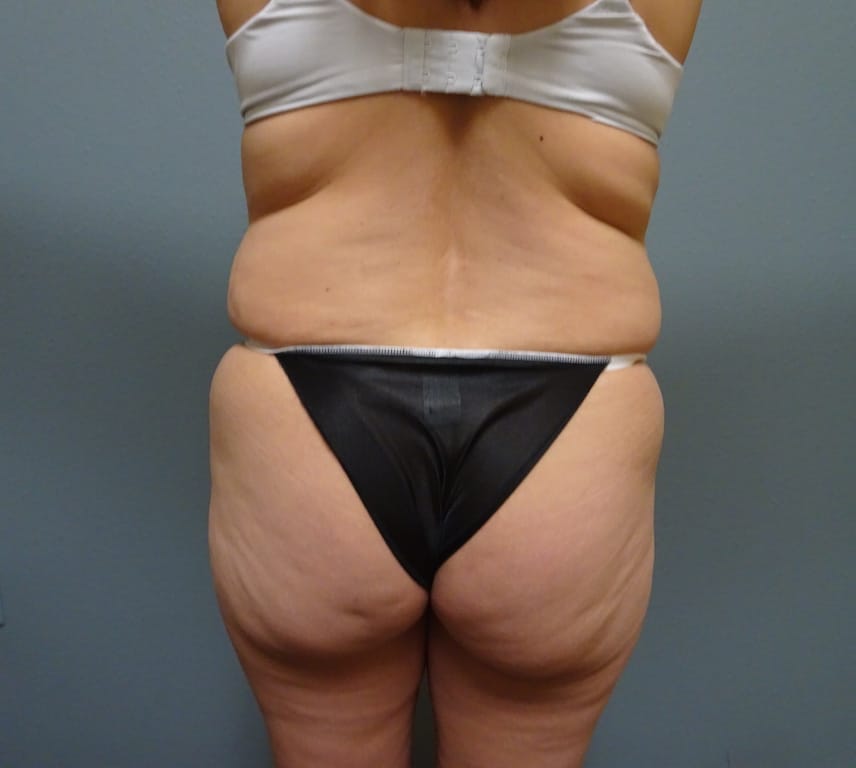 patient60-lipo-back-before