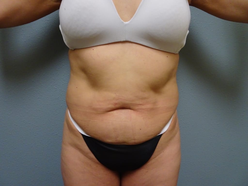 patient60-lipo-front-before