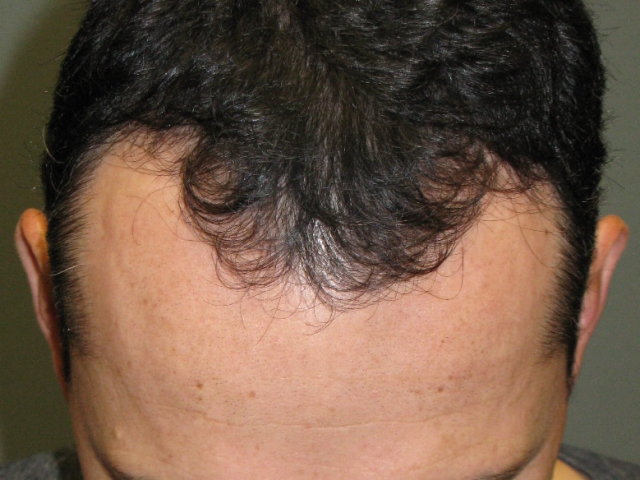 hair-restoration-before