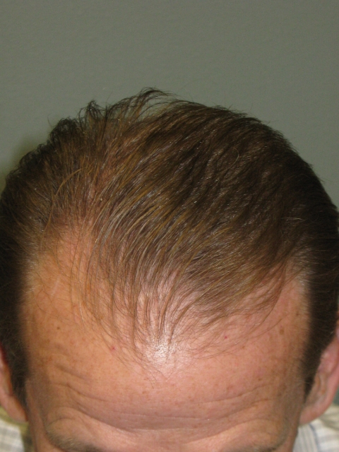 hair-restoration-before