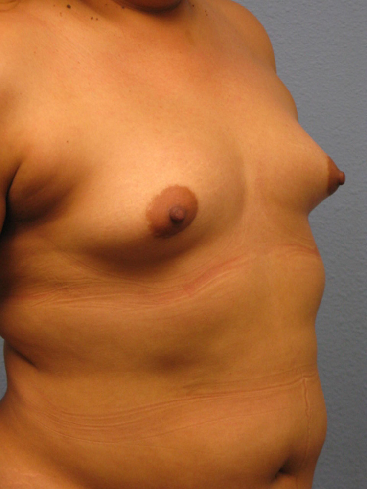 breast-augmentation-angle-right