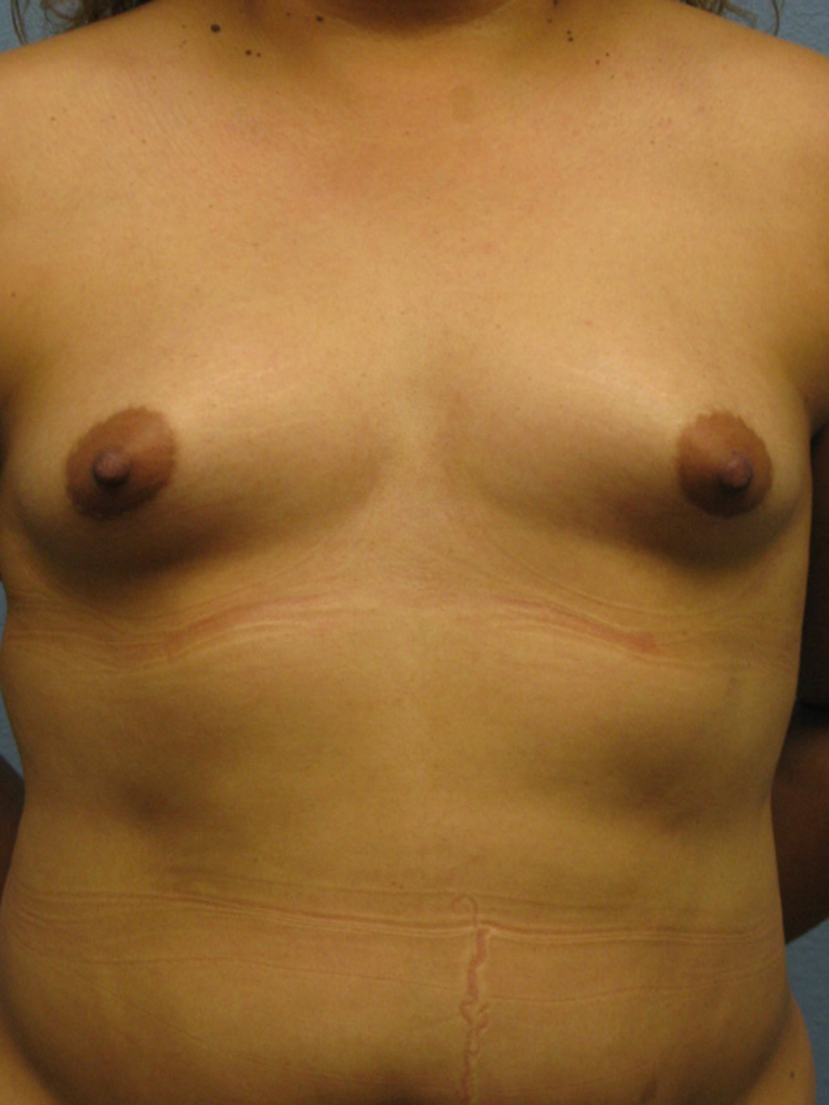 breast-augmentation-front-before