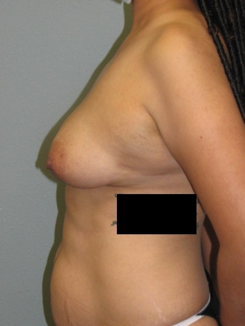 breast-aug-5