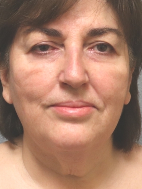 facelift-#4-3