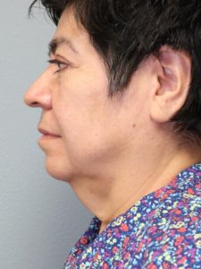 after facelift