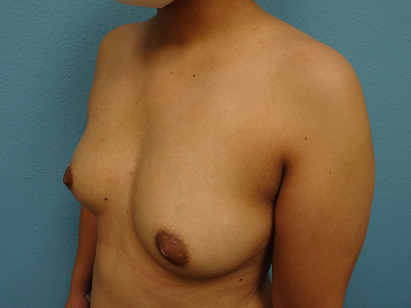 reynolds-breast-aug-ba-b-left-angle-32422-252
