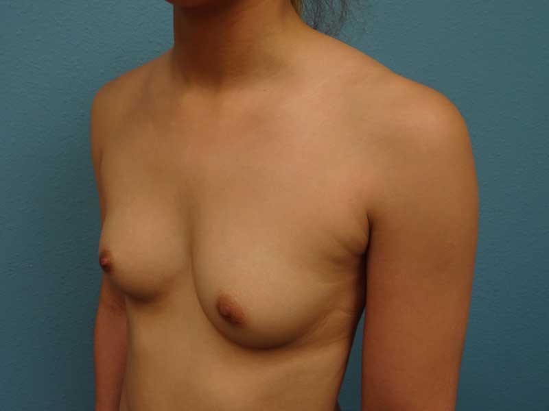 reynolds-breast-aug-ba-b-left-angle-32922-254