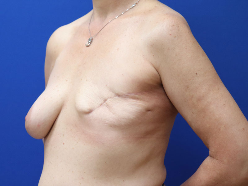 aburto-breast-reconstruction-breast-lift-mastopexy-ba-b-angle