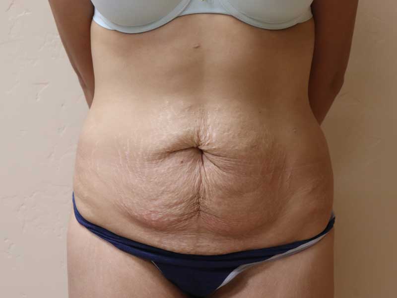 aburto-abdominoplasty-ba-b-1