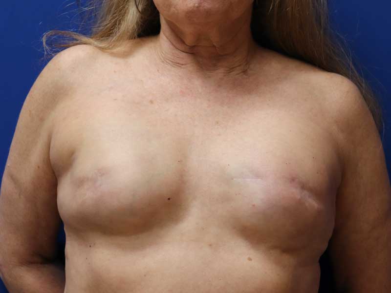 aburto-breast-reconstruction-ba-b-4
