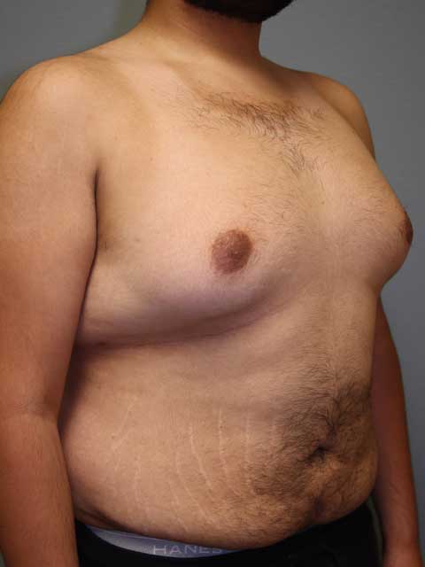 aburto-ba-gynecomastia-procedure-b-side-1022