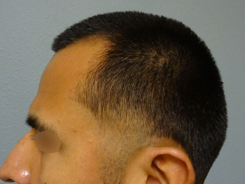 reynolds-hair-resto-ba-b-left-side