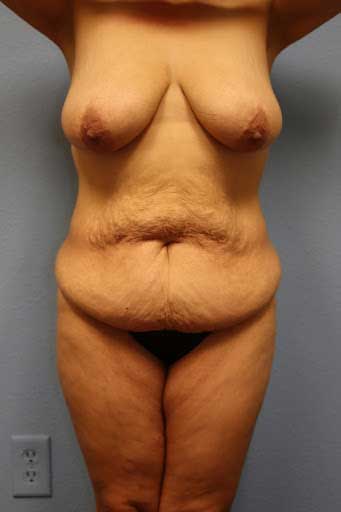 ab-breast-reduc-panniculectomy-front-b