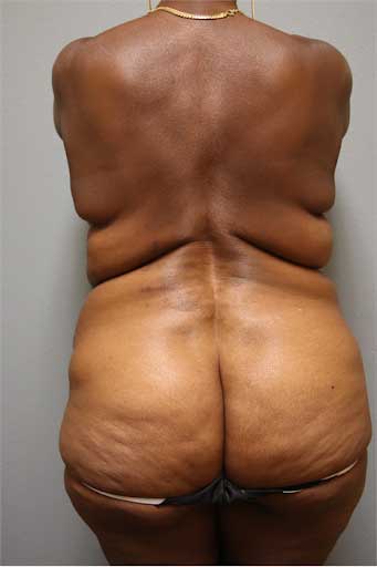 ab-tummy-tuck-sl21-front-b