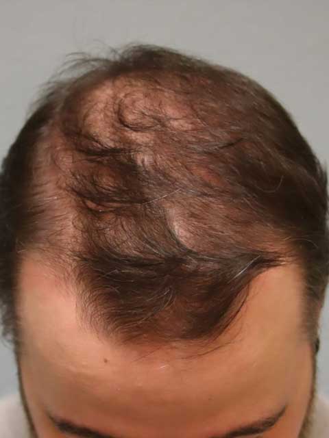 hair-restoration-aburto-ba-front-b.jpg