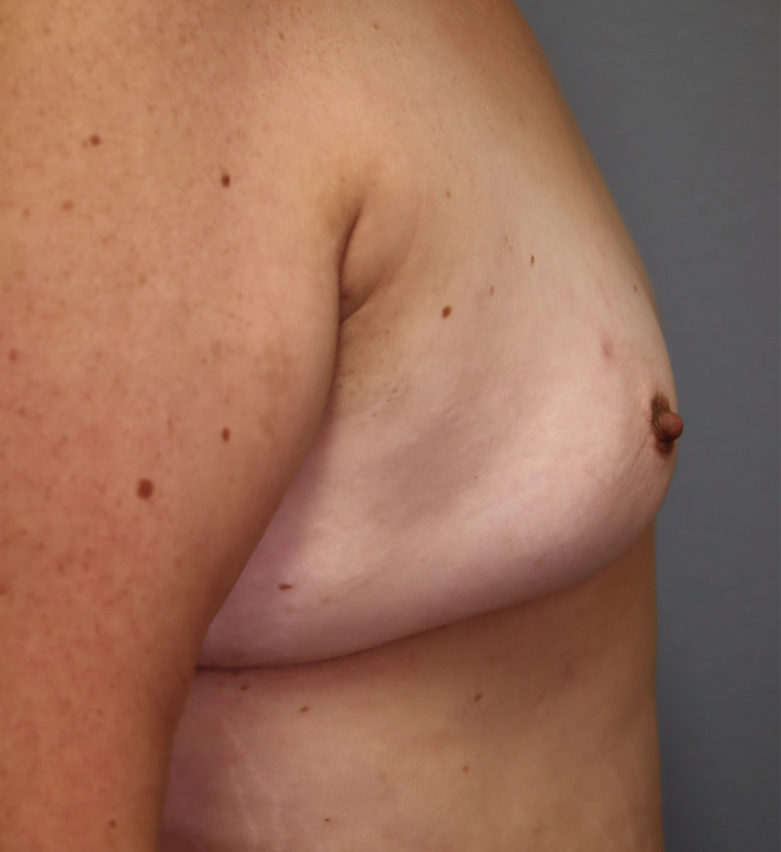 breast-augmentation-side-before
