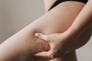 cellulite patient in el paso