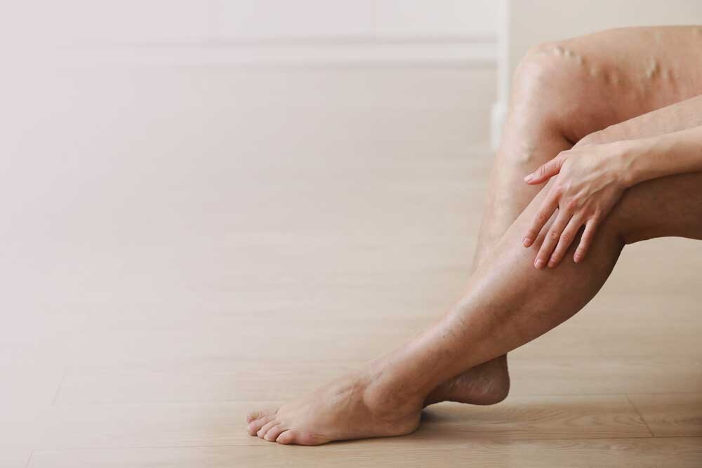 patient in el paso with spider veins